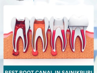 expert-root-canal-treatment-at-universal-dental-hospital-save-your-natural-tooth