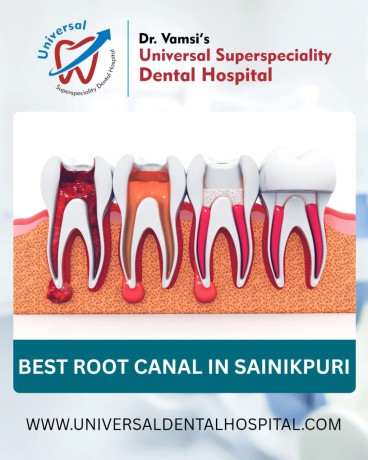 expert-root-canal-treatment-at-universal-dental-hospital-save-your-natural-tooth-big-0