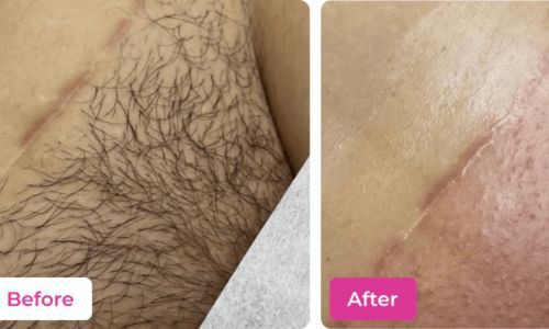 get-salon-smooth-results-with-the-best-bikini-hair-removal-wax-big-1