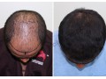 best-hair-transplant-in-bangalore-hair-transplant-clinic-small-1