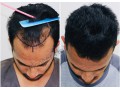 best-hair-transplant-in-bangalore-hair-transplant-clinic-small-3
