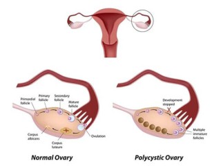 best-age-to-get-pregnant-with-pcos