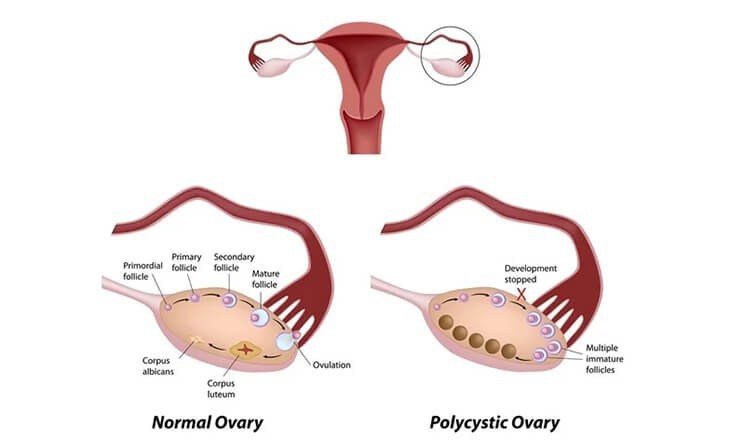 best-age-to-get-pregnant-with-pcos-big-0